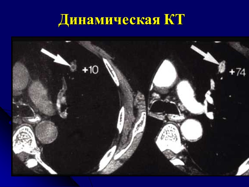 КТ-признаки  периферического рака Форма  округлая неправильная Контуры бугристые нечеткие Лимфангит:  аденокарцинома